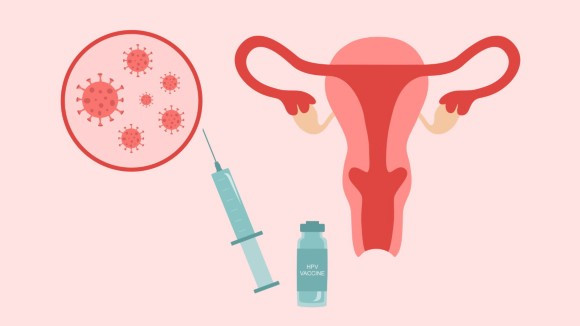 Vaksinasi HPV untuk Wanita Pranikah dan Pascapersalinan